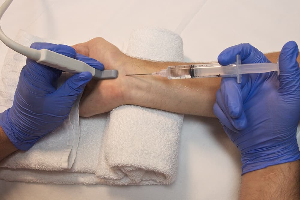 Carpal Tunnel Injections