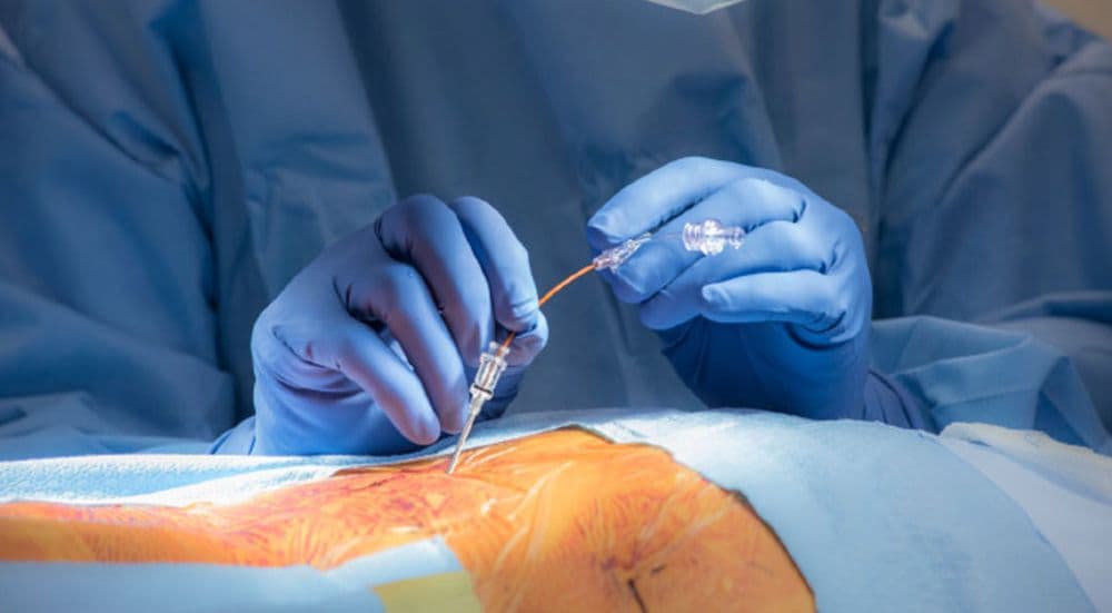 Dorsal Root Ganglion (DRG) Stimulation