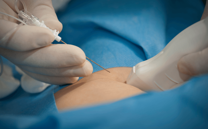 Peripheral Nerve Blocks